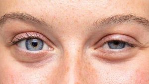 Sụp mí mắt có thể bắt nguồn từ nhiều nguyên nhân khác nhau