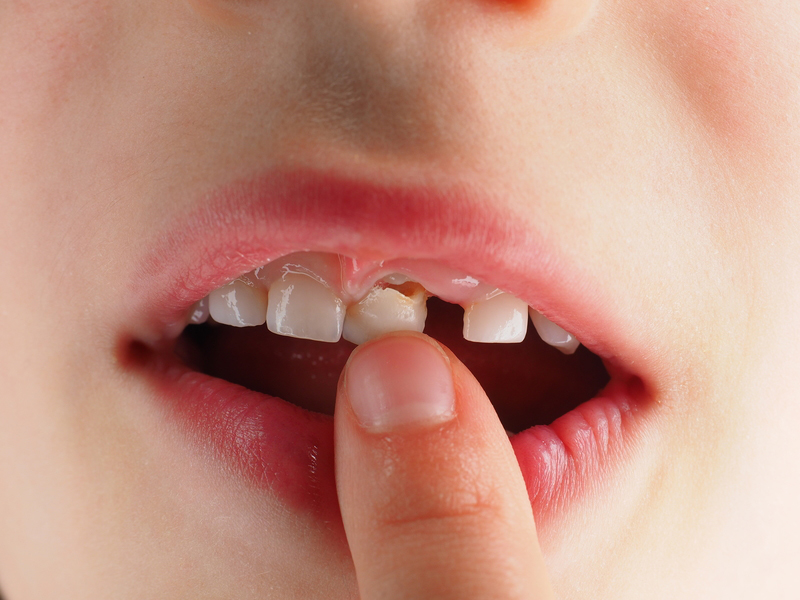 Dấu hiệu thay răng sữa ở trẻ