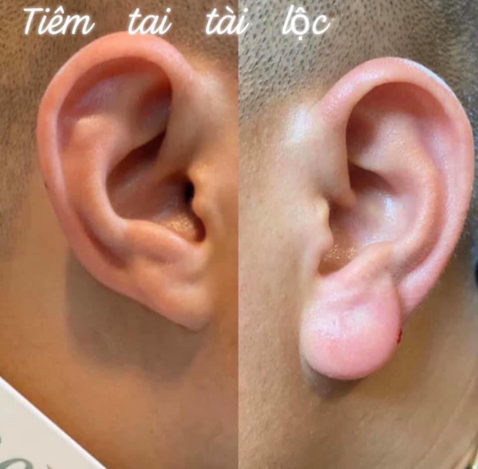 Phẫu thuật thẩm mỹ tai là cách tối ưu để cải thiện tướng tai