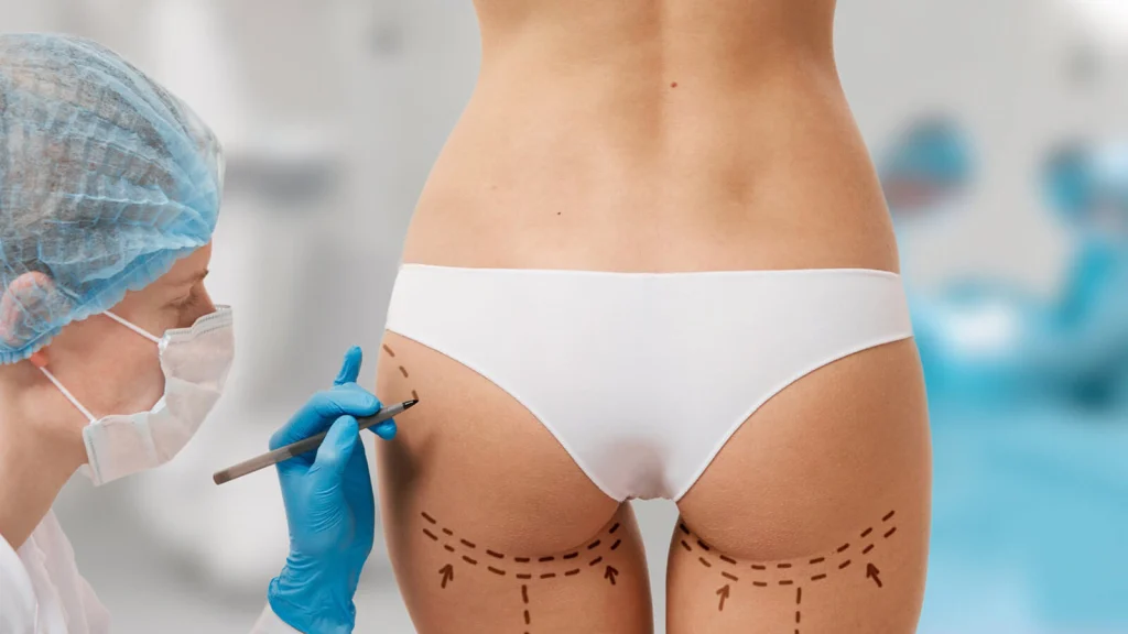 Cấy mỡ mông là phương pháp thẩm mỹ sử dụng mỡ tự thân để cấy vào vùng mông
